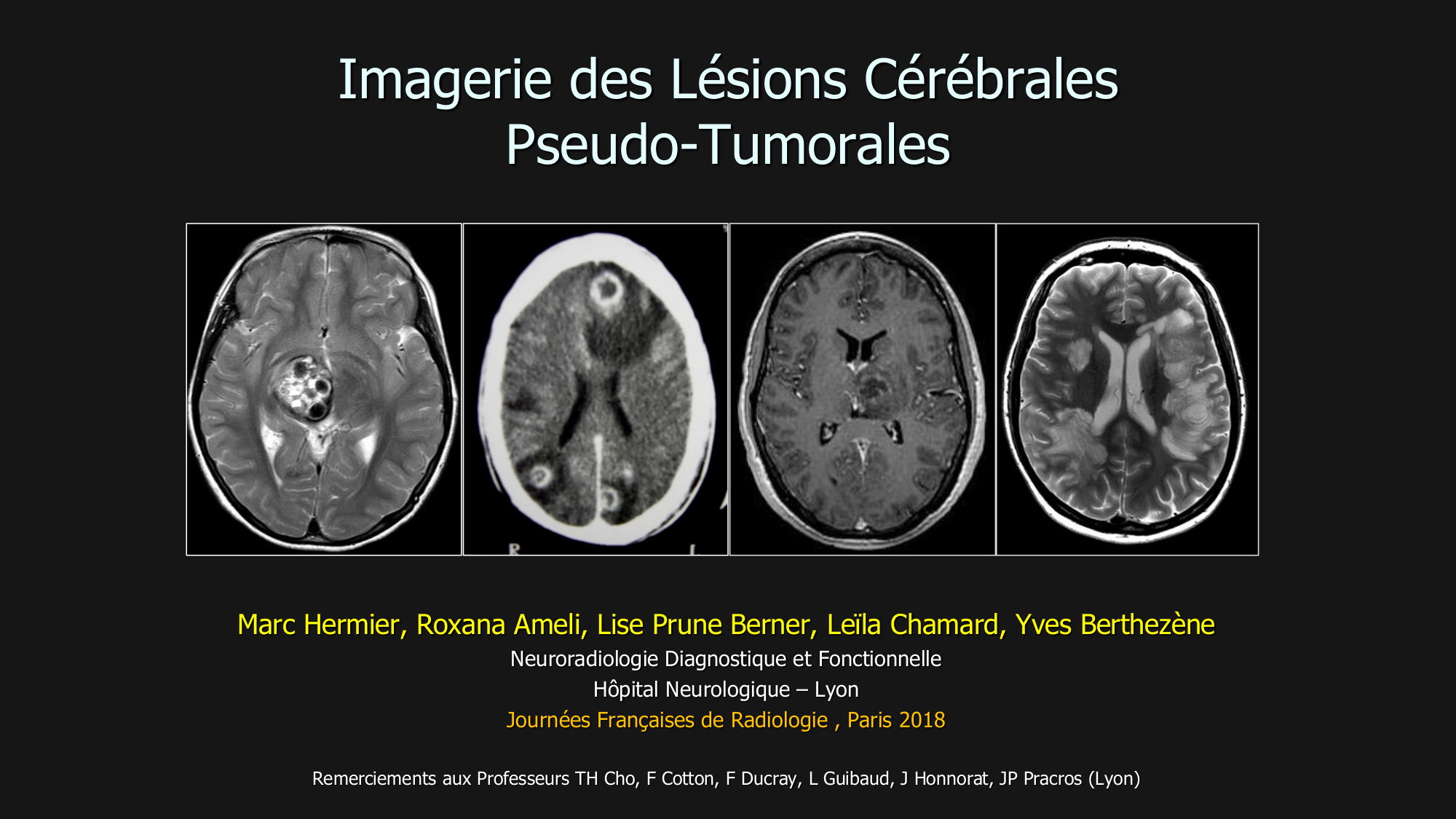 NR-WP-22 - Imagerie des lésions cérébrales pseudo-tumorales